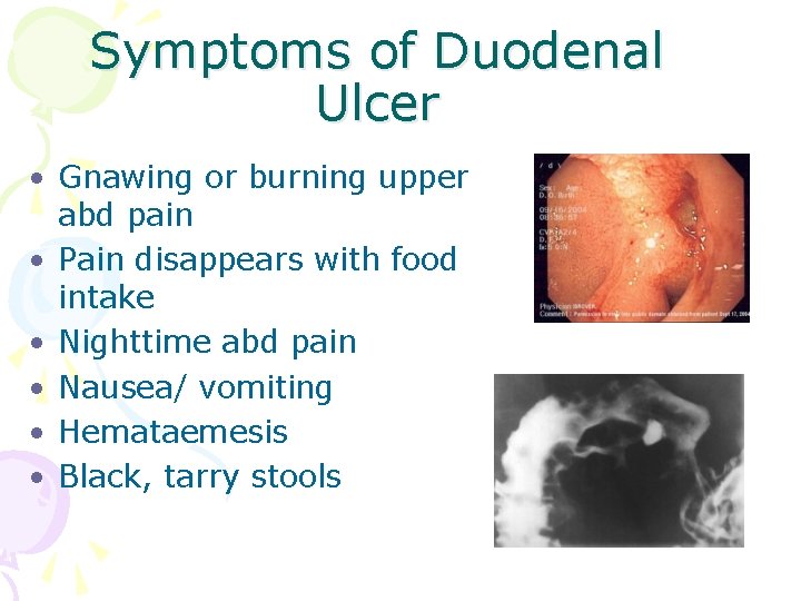 Symptoms of Duodenal Ulcer • Gnawing or burning upper abd pain • Pain disappears