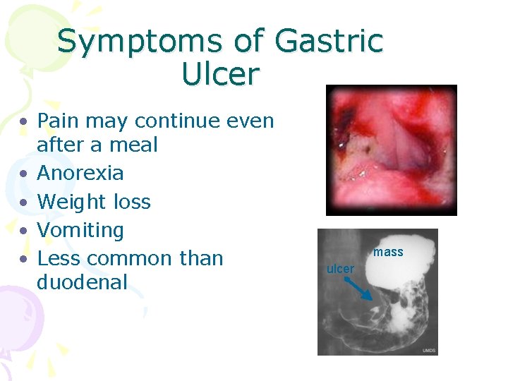 Symptoms of Gastric Ulcer • Pain may continue even after a meal • Anorexia