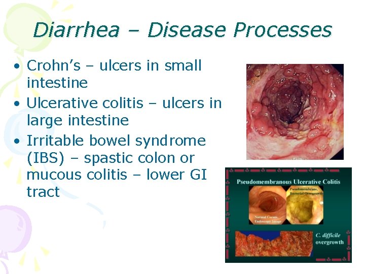 Diarrhea – Disease Processes • Crohn’s – ulcers in small intestine • Ulcerative colitis