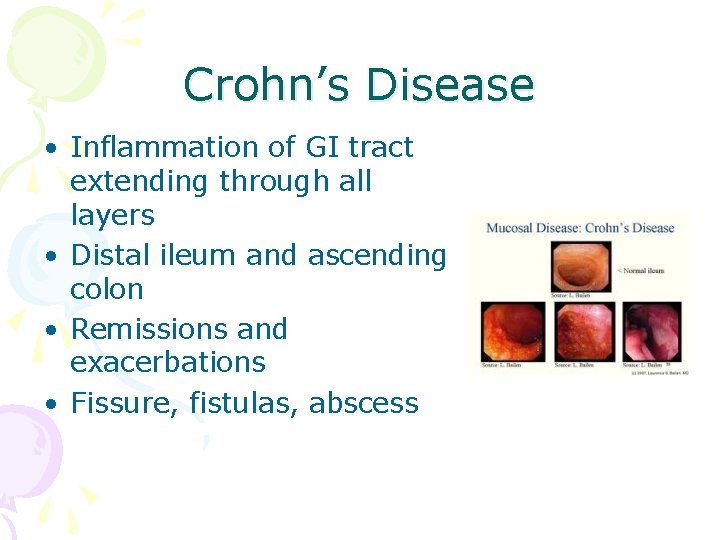 Crohn’s Disease • Inflammation of GI tract extending through all layers • Distal ileum