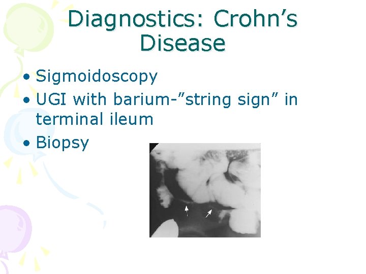 Diagnostics: Crohn’s Disease • Sigmoidoscopy • UGI with barium-”string sign” in terminal ileum •