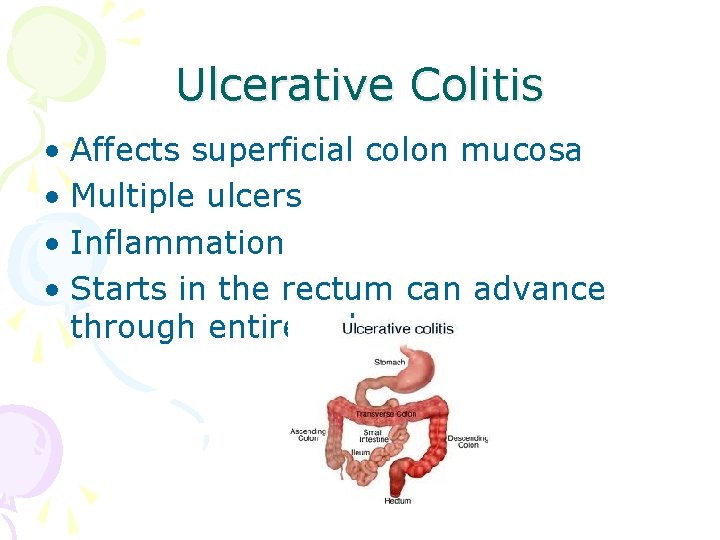 Ulcerative Colitis • Affects superficial colon mucosa • Multiple ulcers • Inflammation • Starts