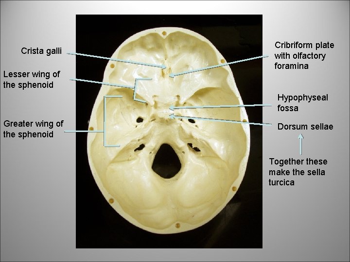 Crista galli Lesser wing of the sphenoid Cribriform plate with olfactory foramina Hypophyseal fossa