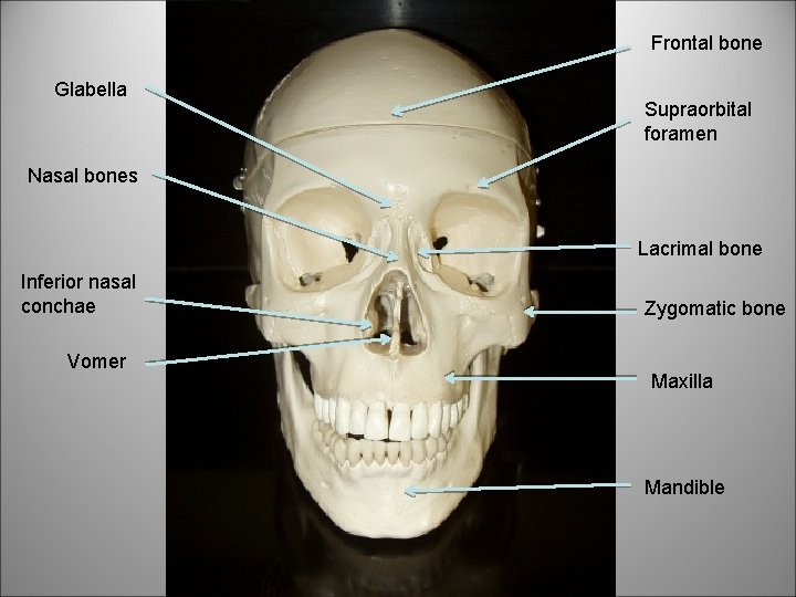 Frontal bone Glabella Supraorbital foramen Nasal bones Lacrimal bone Inferior nasal conchae Vomer Zygomatic