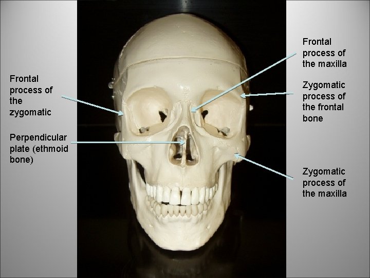 Frontal process of the maxilla Frontal process of the zygomatic Zygomatic process of the