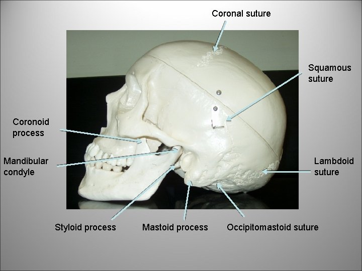 Coronal suture Squamous suture Coronoid process Mandibular condyle Lambdoid suture Styloid process Mastoid process