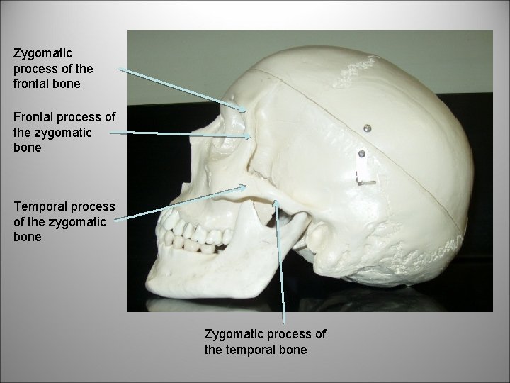 Zygomatic process of the frontal bone Frontal process of the zygomatic bone Temporal process