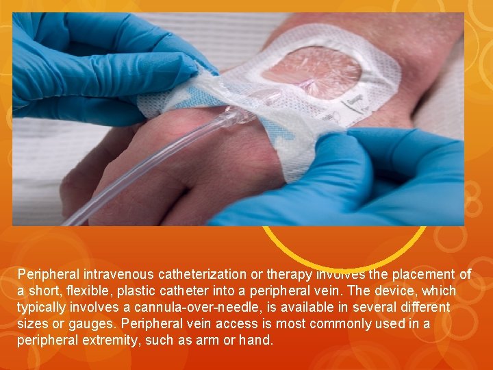 Peripheral intravenous catheterization or therapy involves the placement of a short, flexible, plastic catheter