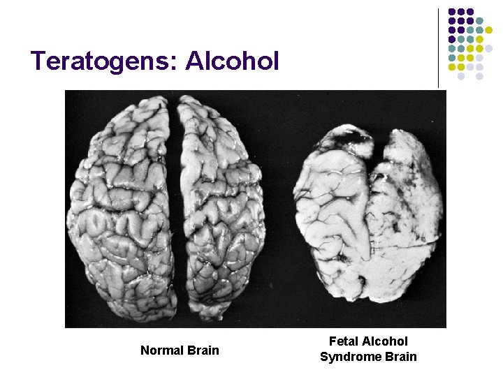Teratogens: Alcohol Normal Brain Fetal Alcohol Syndrome Brain Teratogens: Alcohol Normal Brain Fetal Alcohol Syndrome Brain