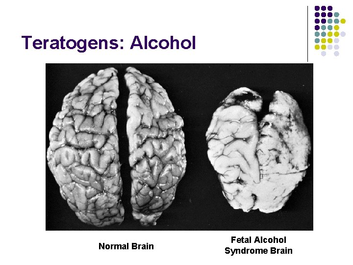 Teratogens: Alcohol Normal Brain Fetal Alcohol Syndrome Brain 