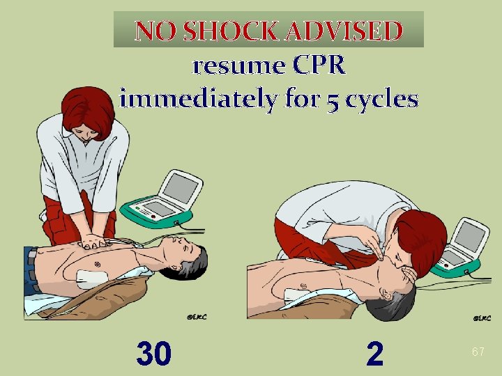 NO SHOCK ADVISED resume CPR immediately for 5 cycles 30 2 67 