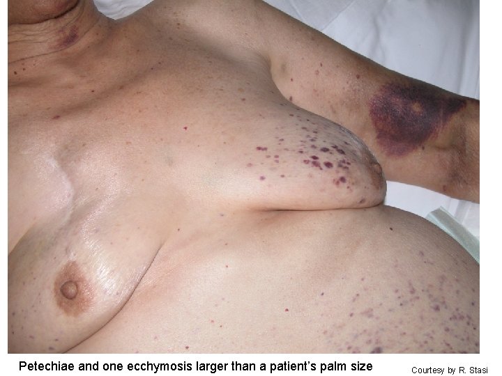 Petechiae and one ecchymosis larger than a patient’s palm size Courtesy by R. Stasi