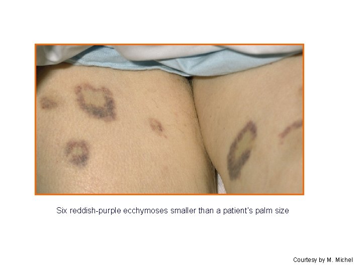 Six reddish-purple ecchymoses smaller than a patient’s palm size Courtesy by M. Michel 