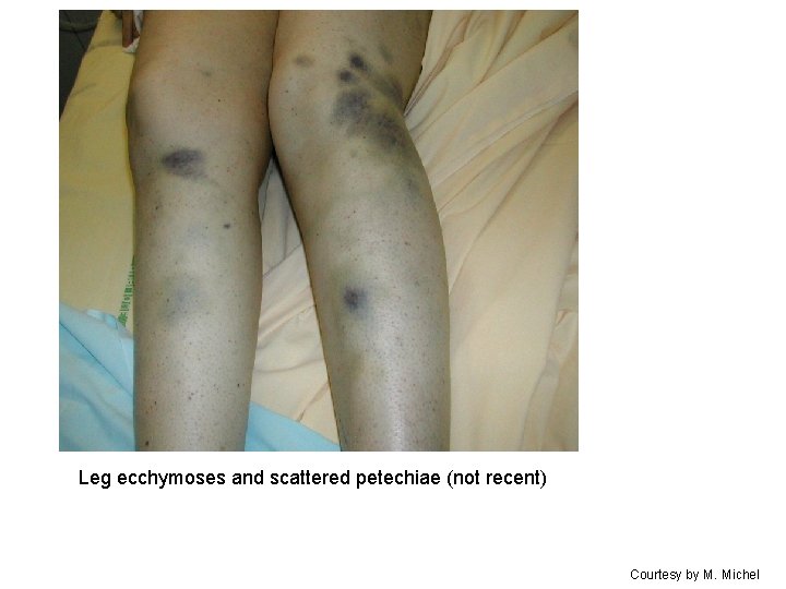 Leg ecchymoses and scattered petechiae (not recent) Courtesy by M. Michel 