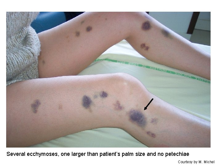 Several ecchymoses, one larger than patient’s palm size and no petechiae Courtesy by M.