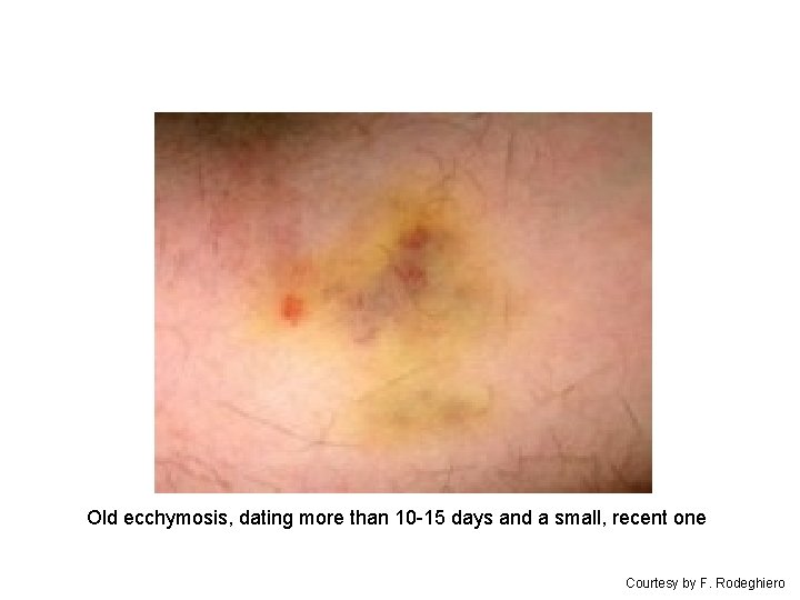 Old ecchymosis, dating more than 10 -15 days and a small, recent one Courtesy