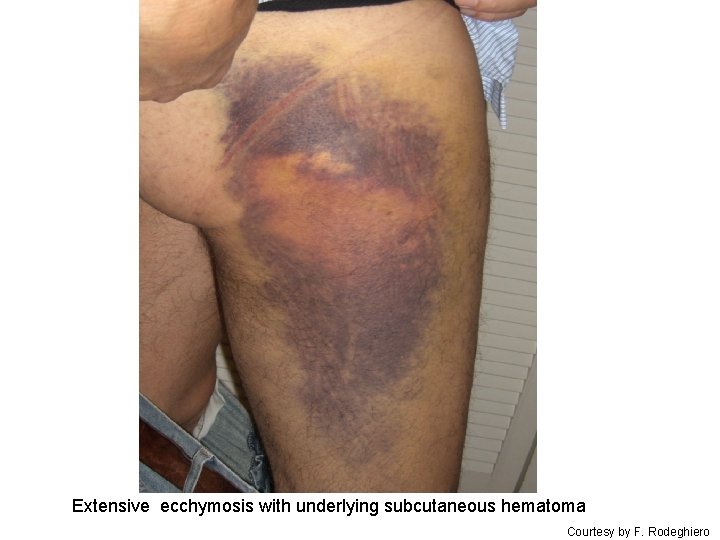 Extensive ecchymosis with underlying subcutaneous hematoma Courtesy by F. Rodeghiero 