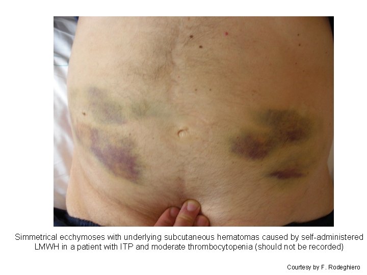 Simmetrical ecchymoses with underlying subcutaneous hematomas caused by self-administered LMWH in a patient with