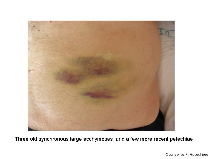 Three old synchronous large ecchymoses and a few more recent petechiae Courtesy by F.
