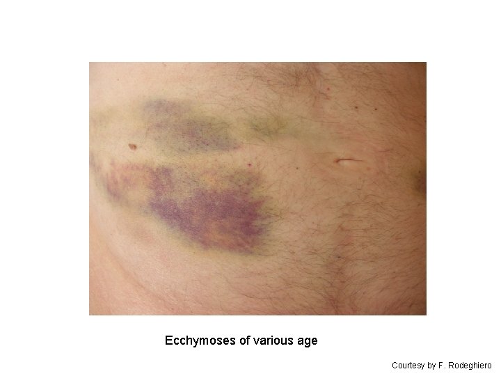 Ecchymoses of various age Courtesy by F. Rodeghiero 