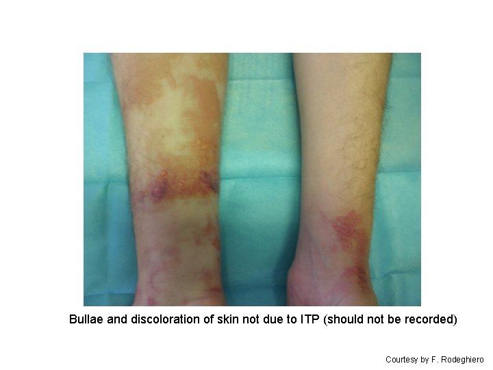 Bullae and discoloration of skin not due to ITP (should not be recorded) Courtesy