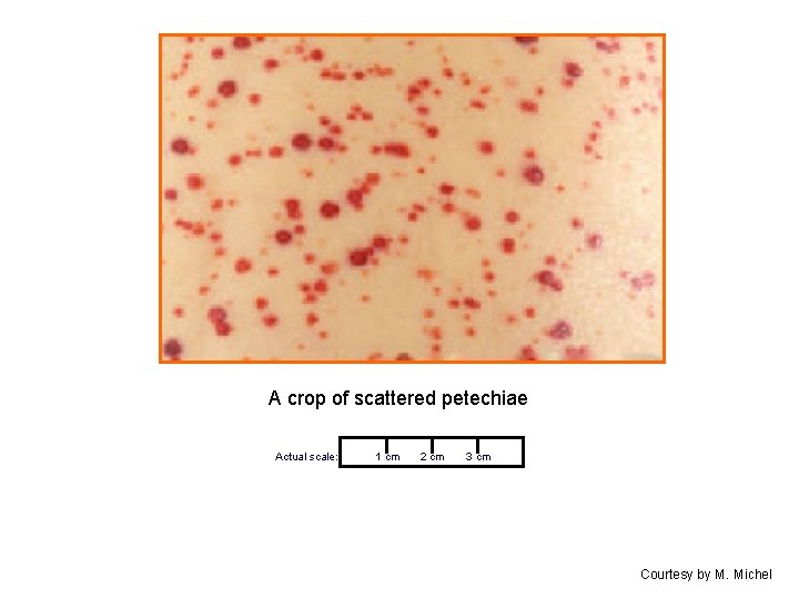 A crop of scattered petechiae Actual scale: 1 cm 2 cm 3 cm Courtesy