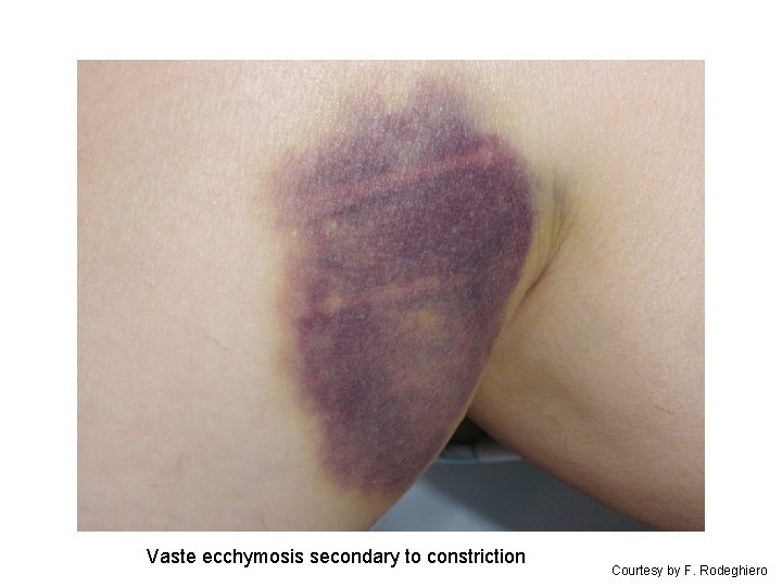 Vaste ecchymosis secondary to constriction Courtesy by F. Rodeghiero 