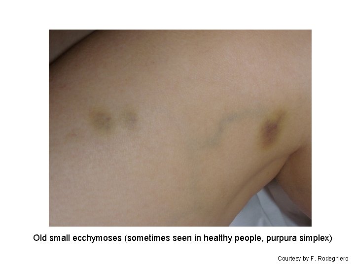 Old small ecchymoses (sometimes seen in healthy people, purpura simplex) Courtesy by F. Rodeghiero