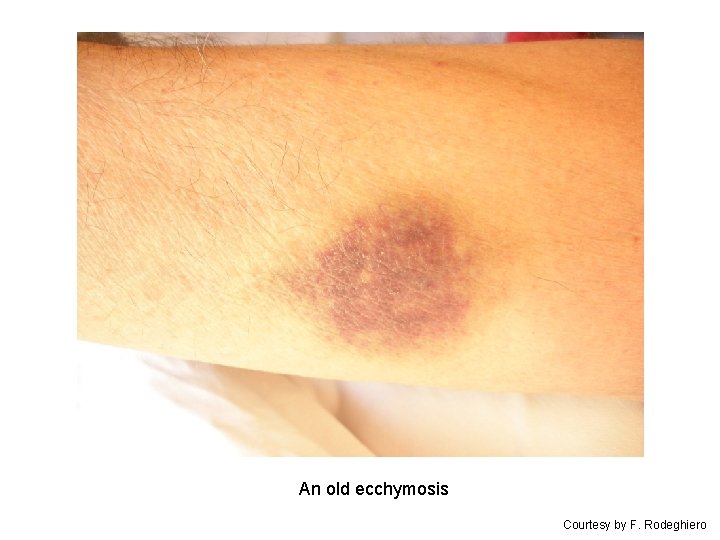 An old ecchymosis Courtesy by F. Rodeghiero 