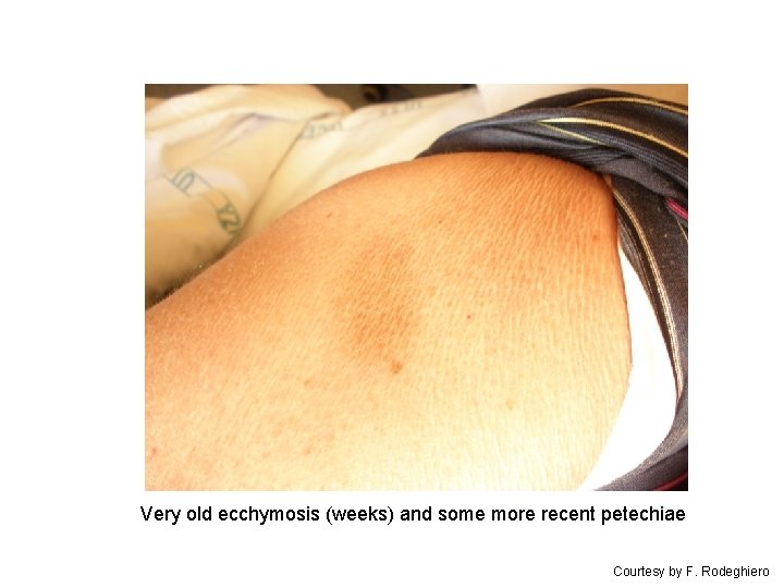 Very old ecchymosis (weeks) and some more recent petechiae Courtesy by F. Rodeghiero 