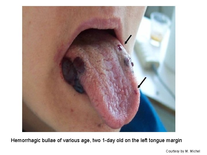 Hemorrhagic bullae of various age, two 1 -day old on the left tongue margin