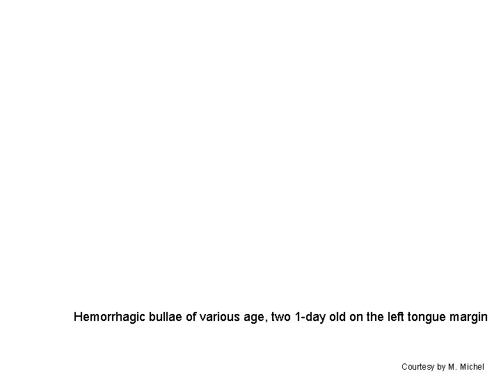 Hemorrhagic bullae of various age, two 1 -day old on the left tongue margin