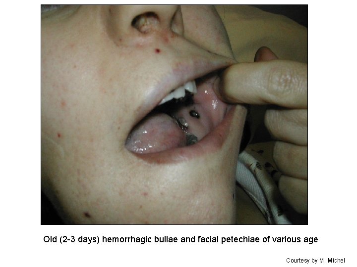 Old (2 -3 days) hemorrhagic bullae and facial petechiae of various age Courtesy by