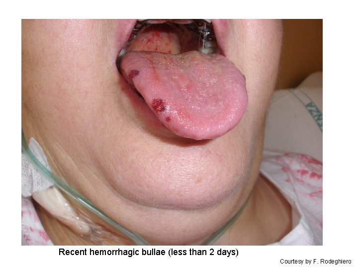 Recent hemorrhagic bullae (less than 2 days) Courtesy by F. Rodeghiero 