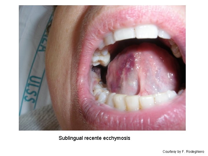 Sublingual recente ecchymosis Courtesy by F. Rodeghiero 