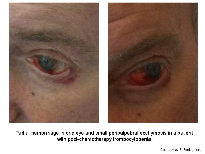 Partial hemorrhage in one eye and small peripalpebral ecchymosis in a patient with post-chemotherapy