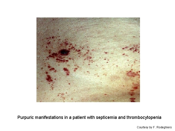 Purpuric manifestations in a patient with septicemia and thrombocytopenia Courtesy by F. Rodeghiero 