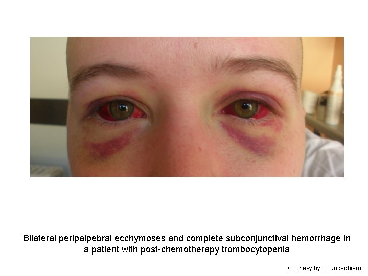 Bilateral peripalpebral ecchymoses and complete subconjunctival hemorrhage in a patient with post-chemotherapy trombocytopenia Courtesy