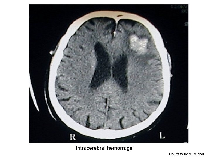 Intracerebral hemorrage Courtesy by M. Michel 