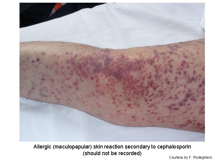 Allergic (maculopapular) skin reaction secondary to cephalosporin (should not be recorded) Courtesy by F.