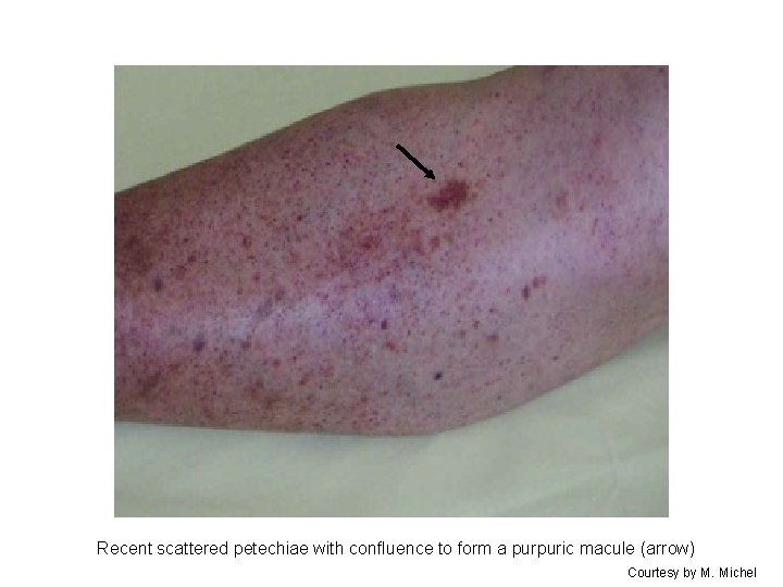 Recent scattered petechiae with confluence to form a purpuric macule (arrow) Courtesy by M.