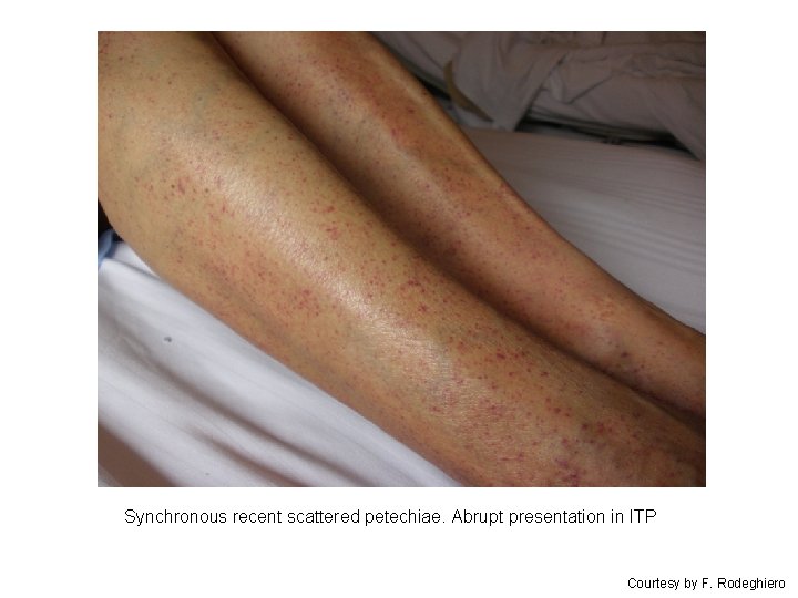 Synchronous recent scattered petechiae. Abrupt presentation in ITP Courtesy by F. Rodeghiero 