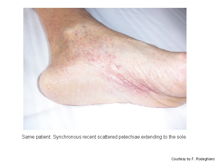 Same patient. Synchronous recent scattered petechiae extending to the sole. Courtesy by F. Rodeghiero