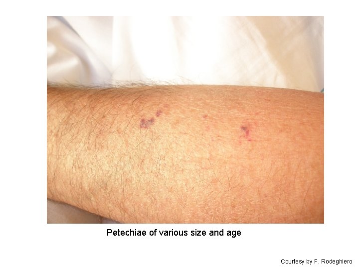 Petechiae of various size and age Courtesy by F. Rodeghiero 
