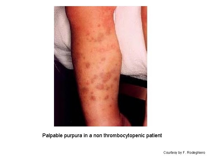 Palpable purpura in a non thrombocytopenic patient Courtesy by F. Rodeghiero 