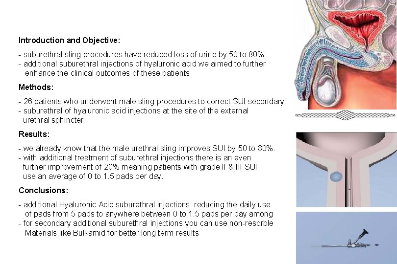 Introduction and Objective: - suburethral sling procedures have reduced loss of urine by 50