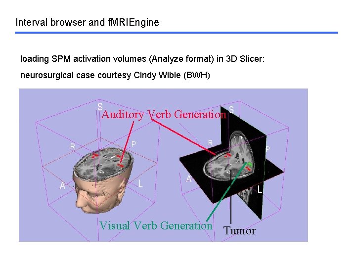 Interval browser and f. MRIEngine loading SPM activation volumes (Analyze format) in 3 D
