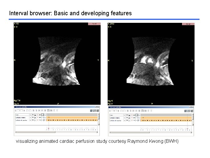 Interval browser: Basic and developing features visualizing animated cardiac perfusion study courtesy Raymond Kwong