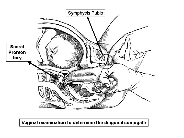 Symphysis Pubis Sacral Promon tory Vaginal examination to determine the diagonal conjugate 