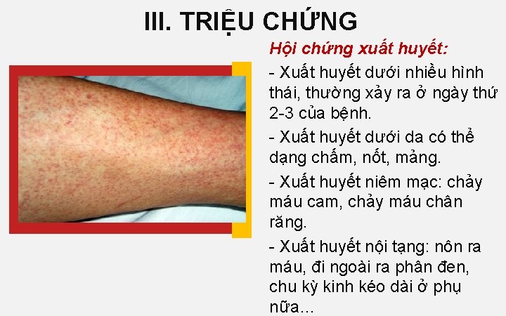 III. TRIỆU CHỨNG Hội chứng xuất huyết: - Xuất huyết dưới nhiều hình thái,